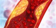 Artery Plaques